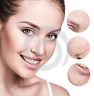 Circles shows problem skin of young woman.