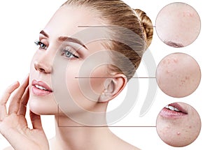 Circles shows problem skin of young woman.