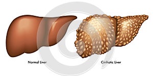 Cirrhosis photo