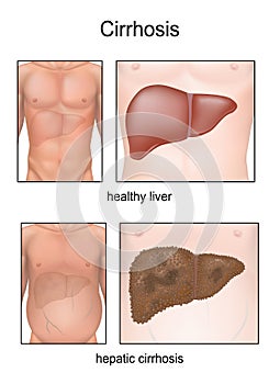 Cirrhosis. photo