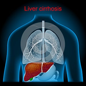 Cirrhosis. liver have damage photo