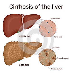 Cirrhosis of the liver photo