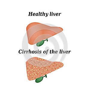Cirrhosis of the liver. Vector illustration on