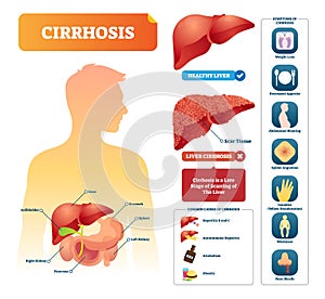 Cirrhosis vector illustration. Labeled medical diagram with illness symptom photo