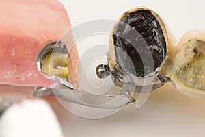 Clasp prosthesis with lock fixation
