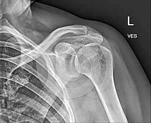 Clavicle bone, Shoulder Medical Xray