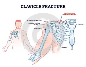 Clavicle fracture anatomy and broken shoulder collarbone outline diagram