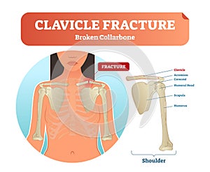 Clavicle fracture with broken collarbone vector illustration. Medical and anatomical labeled scheme with clavicle fracture. photo