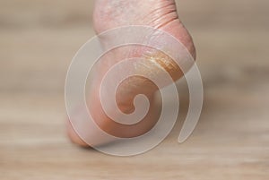 Clavus and cracks on the heel of the foot