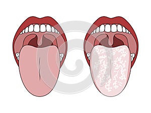 Clean Healthy Tongue and White Coated Tongue.