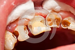 Cleaned cavities photo