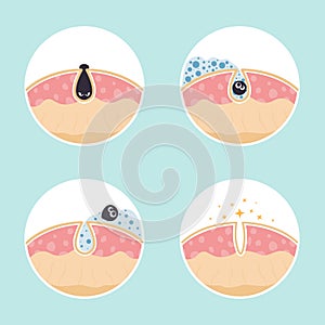 Cleaning clogged pores process flat vector illustration. Steps of blackheads, sebum or pimples removal, skin cleaning photo