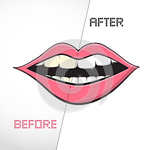 Cleaning Teeth, Before and After