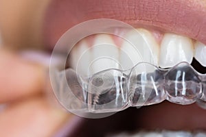 Clear Aligners and Dental Night Guard