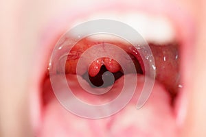 Cleft, bifurcation of the uvula. malformations.