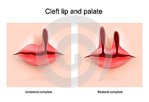 Cleft lip and cleft palate