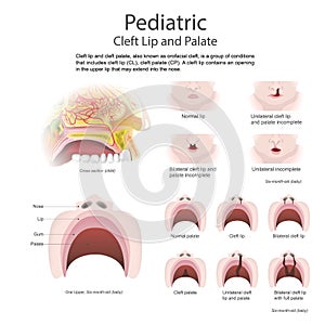 Cleft lip and cleft palate. Vector Art, Illustration.