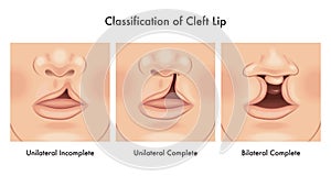 Cleft lip medical illustration
