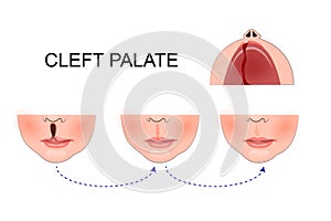 Cleft palate in a child. plastic surgery. reconstruction of the