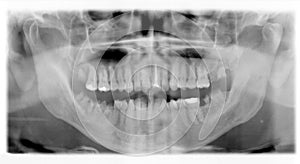 the clinical checkup X-ray dental detail