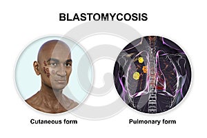 Clinical forms of blastomycosis, 3D illustration