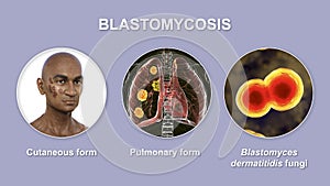 Clinical forms of blastomycosis, 3D illustration