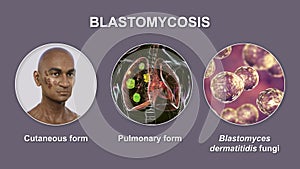 Clinical forms of blastomycosis, 3D illustration