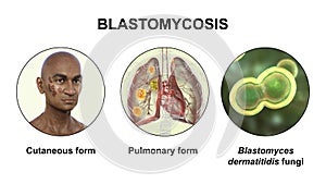 Clinical forms of blastomycosis, 3D illustration