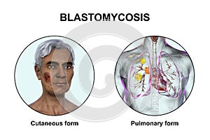 Clinical forms of blastomycosis, 3D illustration
