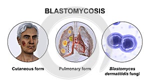 Clinical forms of blastomycosis, 3D illustration