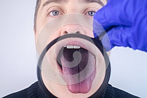 Close-up of a man black tongue. Clinical manifestations of lingua villosa. Bacterial infection of the mouth. The consequences of photo
