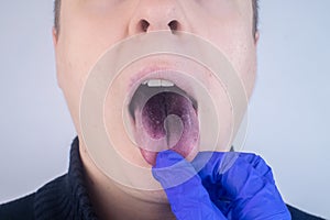 Close-up of a man black tongue. Clinical manifestations of lingua villosa. Bacterial infection of the mouth. The consequences of photo