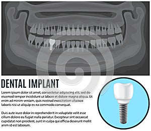 Clipping from article about dental implants. X-ray of human jaw with healthy teeth and prosthesis