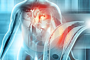 Clogged Artery, Arteriosclerosis Cholesterol plaque