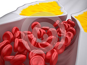 Clogged Artery - Atherosclerosis / Arteriosclerosis - Cholesterol plaque - detailed view