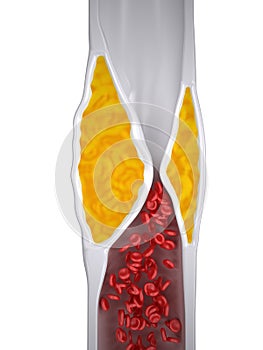 Clogged Artery - Atherosclerosis / Arteriosclerosis - Cholesterol plaque - top view photo