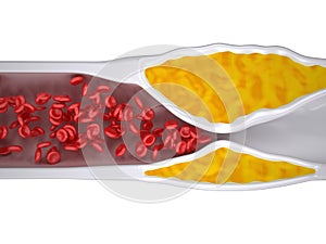 Clogged Artery - Atherosclerosis / Arteriosclerosis - Cholesterol plaque - top view photo