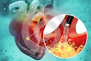 Clogged artery and atherosclerosis disease