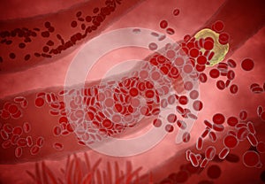 Clogged Artery with platelets and cholesterol plaque, concept for health risk for obesity or dieting and nutrition problems