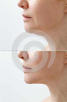 A close portrait of an aged woman before and after facial rejuvenation procedure. Correction of the chin shape