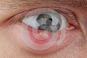 Close up abscess in the eye. hordeolum. stybarley on the eye. inflammation. stye