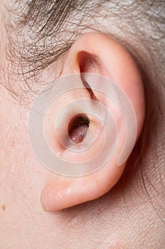 Close up of abscess Inflammation on the ear, area of suppuration. Ear furuncle. Purulent carbuncle. Treatment of abscess