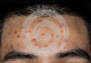 Close up of Acne on the skin, Acne on the face caused by Hormone