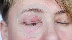 Close Up of Adult woman with Inflamed Eye Looking at Camera.