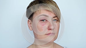 Close Up of Adult woman with Inflamed Eye Looking at Camera.