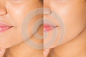Before after close up african american woman face with acne and problem skin. Beauty skin care treatment. Before-after Facial