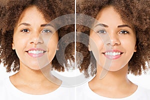 Before after close up african american woman face with acne and problem skin. Beauty skin care treatment. Before-after Facial