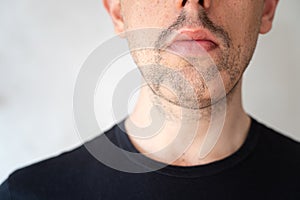 Close up of alopecia areata on a man`s beard