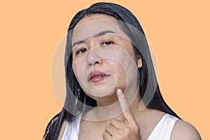 Close up of Asian adult woman face has freckles, large pores, blackhead pimple and scars problem from not take care for a long