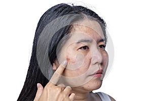 Close up of Asian adult woman face has freckles, large pores, blackhead pimple and scars problem from not take care for a long